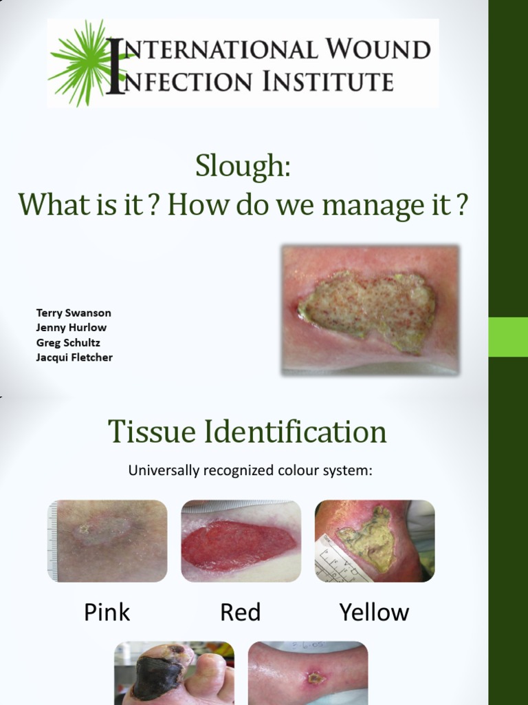 Slough Wound Care Guide